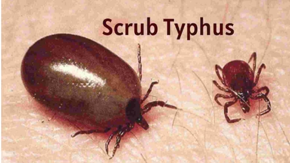 Scrub Typhus Alert: Shimla Woman Tests Positive Amid Rising Monsoon Risks Scrub Typhus Alert: Shimla Woman Tests Positive Amid Rising Monsoon Risks HIMACHAL HEADLINES