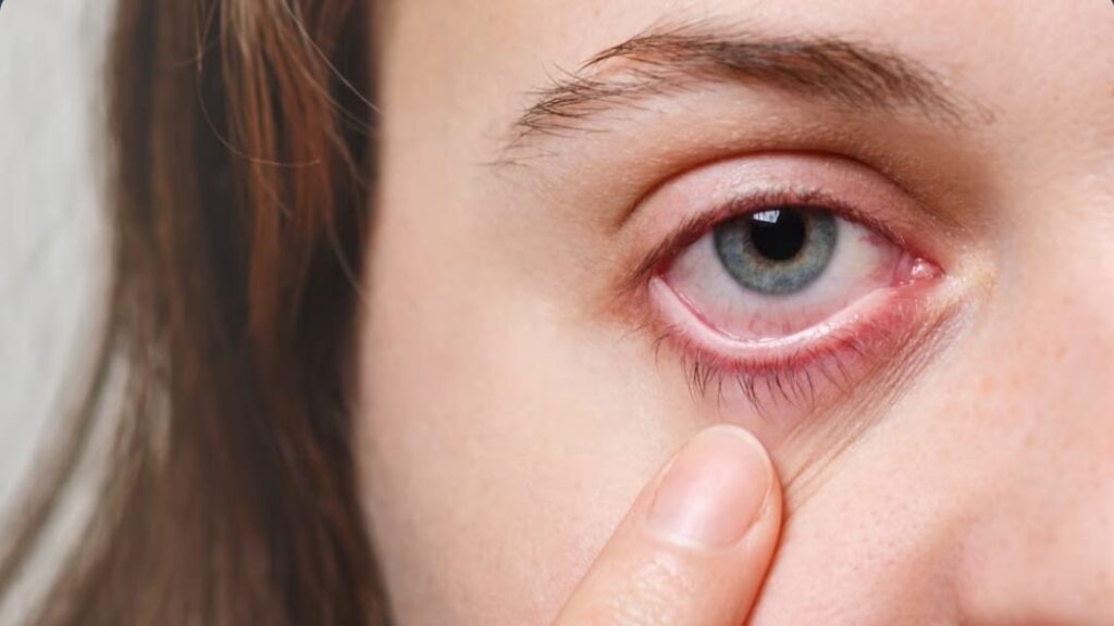 Many students contracted Eye Flu in the Arki subdivision Many students contracted Eye Flu in the Arki subdivision HIMACHAL HEADLINES