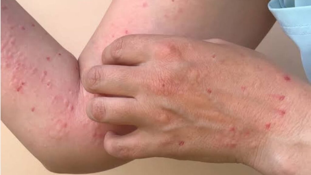 Himachal on Alert as Monkeypox Cases Rise: Here’s What You Need to Know Himachal on Alert as Monkeypox Cases Rise: Here’s What You Need to Know HIMACHAL HEADLINES