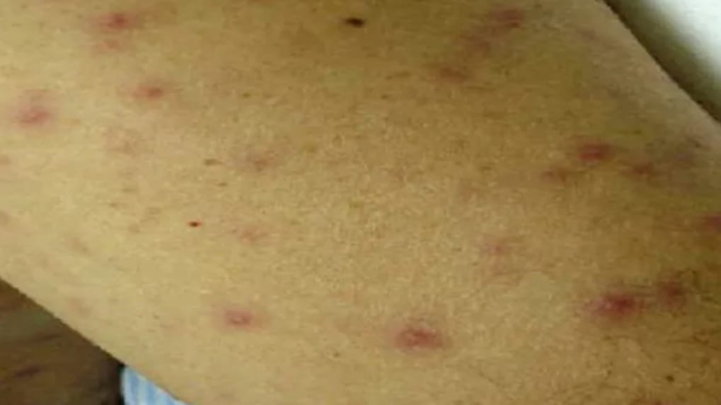 Rising Scrub Typhus death toll in Himachal: Two lives lost in IGMC, Shimla HIMACHAL HEADLINES