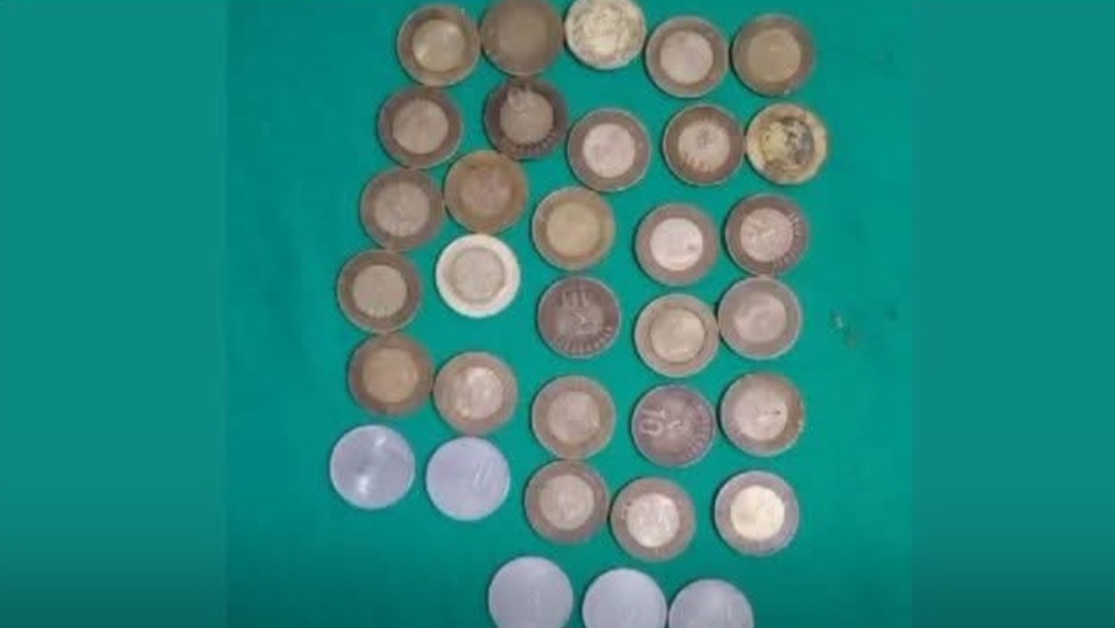 Shocking Medical Case: Doctors Remove 33 Coins from Man’s Stomach in Ghumarwin HIMACHAL HEADLINES